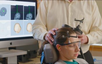 Brain Stimulation Therapy